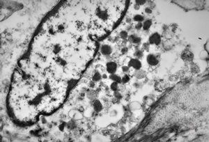 M,43y. | skin - susp. myelosis